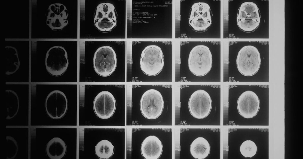 A sheet of CT brain scan images, illustrating a head injury compensation claim